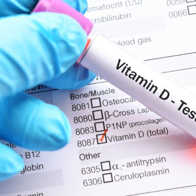test vitamina d